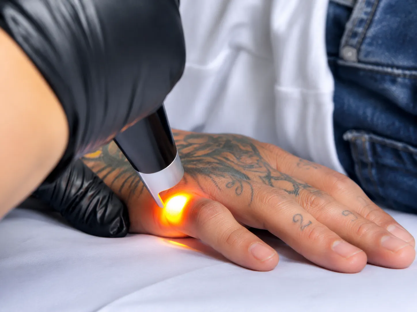 Eliminación de tatuajes